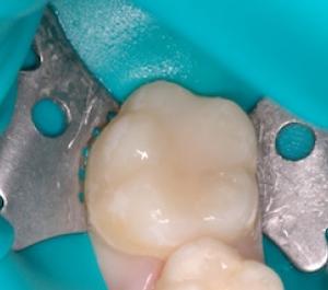 Fissure sealants