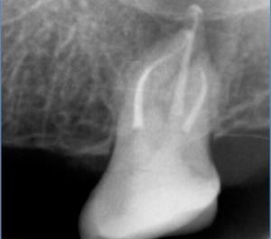 X-ray of a tooth 