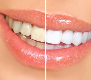 Whitening